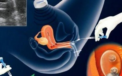 详细解读岑溪市做长方案试管婴儿费用，长方案和短方案成功率有差别吗？