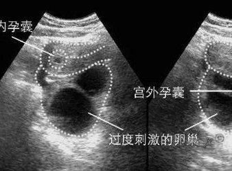 染色体异常不孕能在衡水市人民医院做三代试管怀孩子吗？男人染色体有问题能做试管吗？